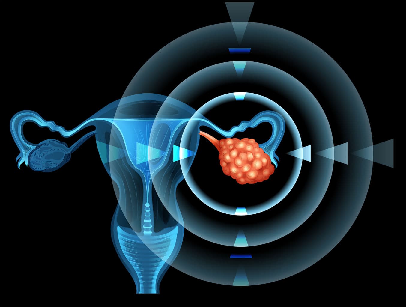 AstraZeneca 聯合 Myriad Genetics！ myChoice HRD Plus 伴隨式診斷將協助卵巢癌臨床試驗