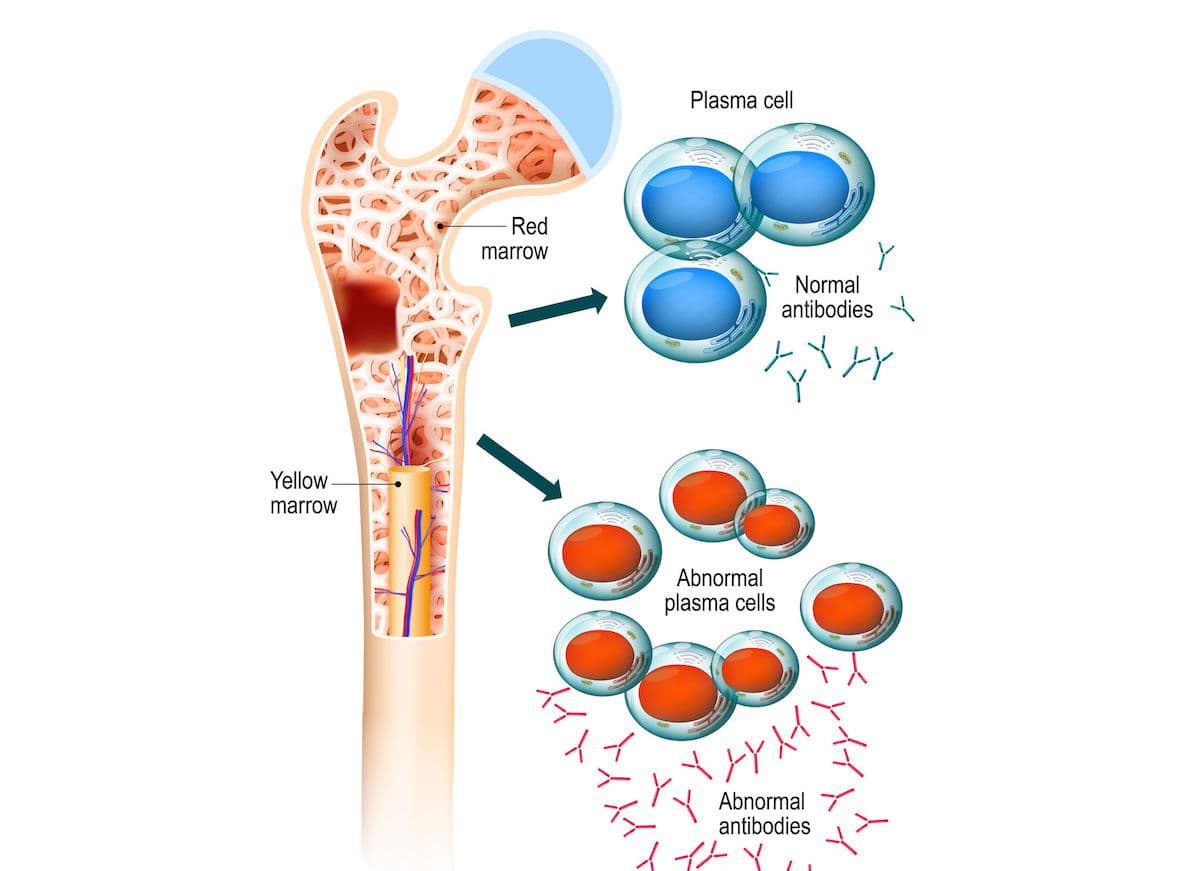 以端粒分析檢測多發性骨髓瘤!Telo Genomics攜手 Mayo Clinic