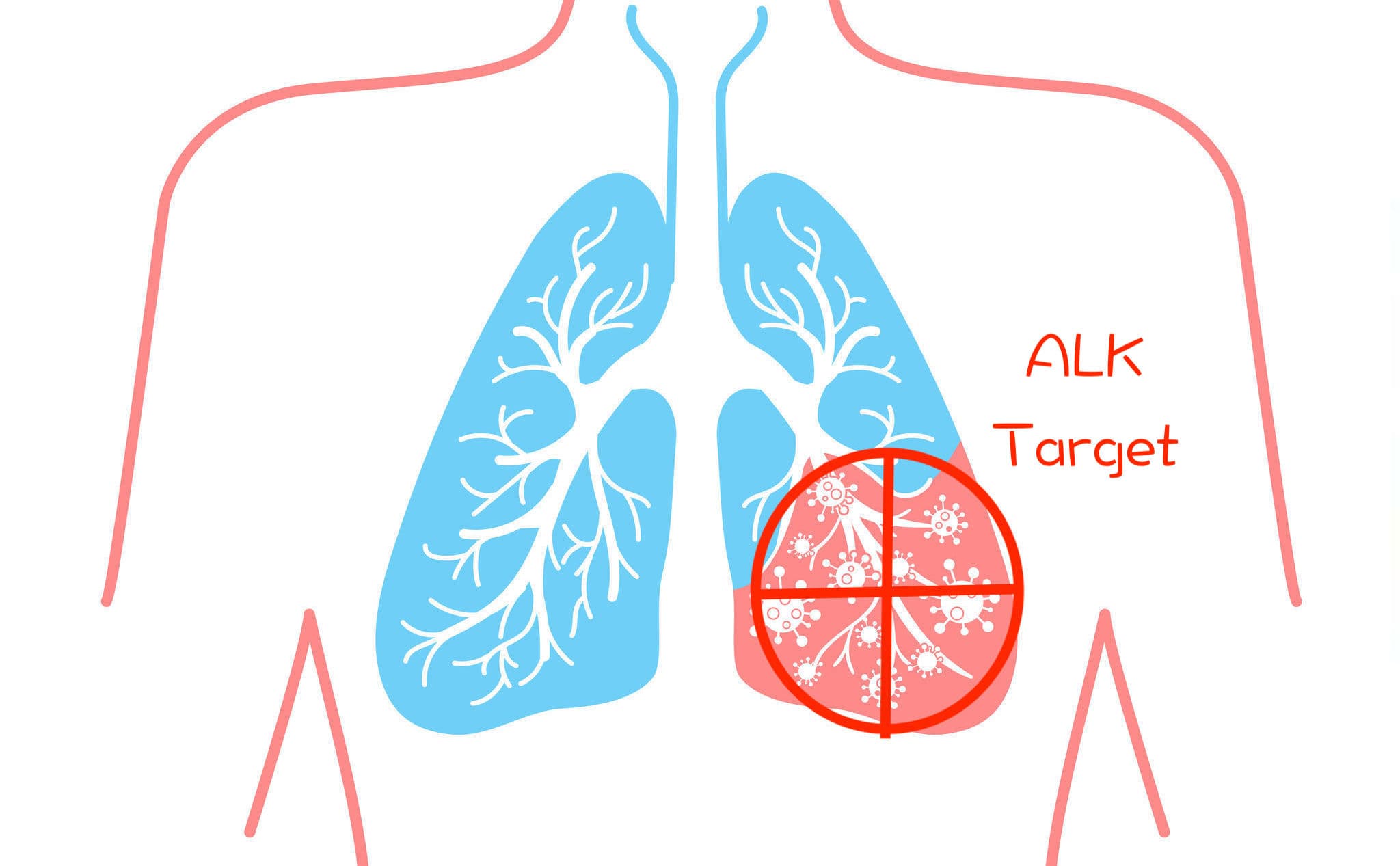 深度解析 ALK 肺癌標靶臨床試驗 ALEX:PFS 為史上最高? OS 大預測?