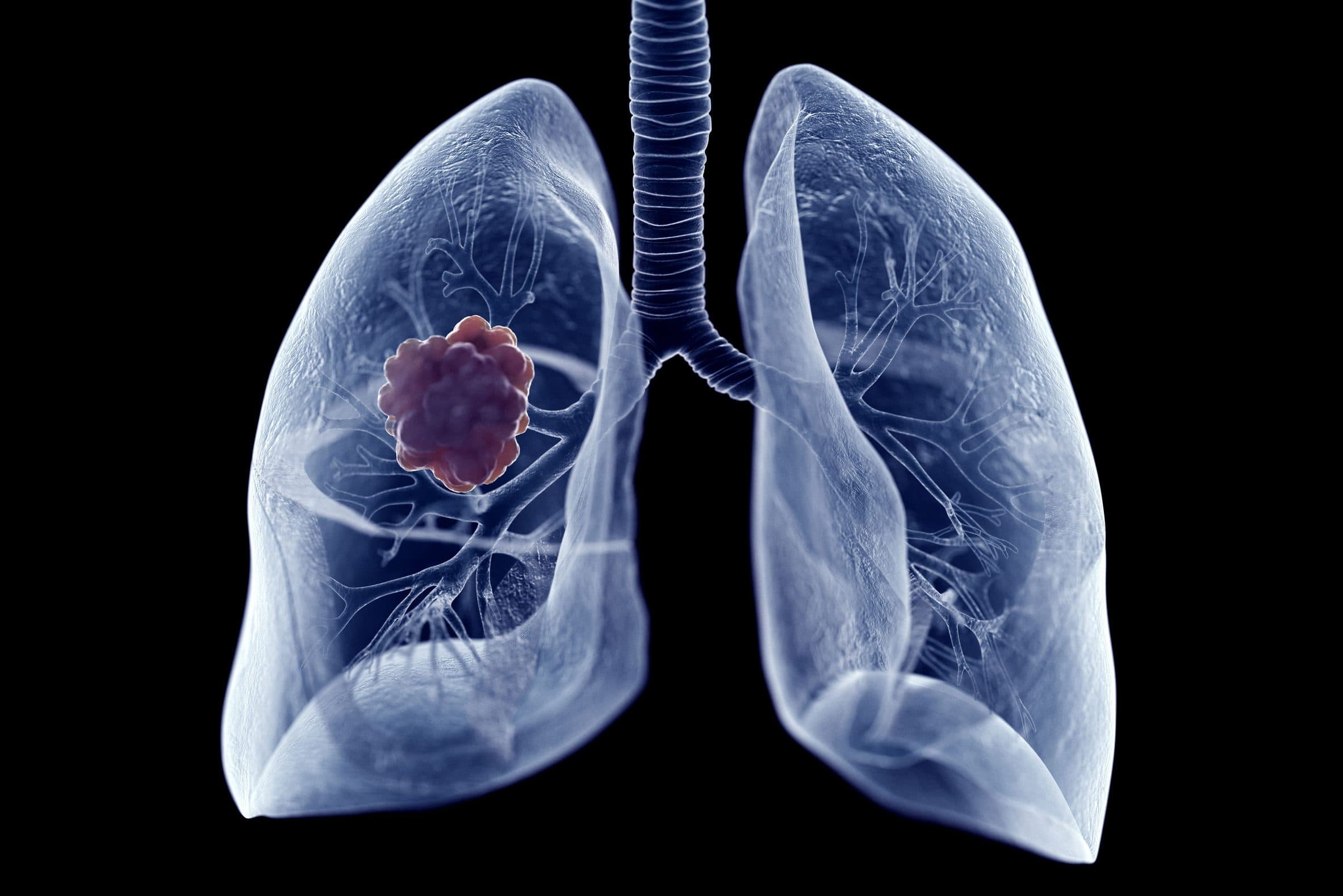 ESMO 2020 肺癌亮點：osimertinib 降低腦轉移風險達 8 成、amivantamab 聯合 lazertinib ORR 達 100%？