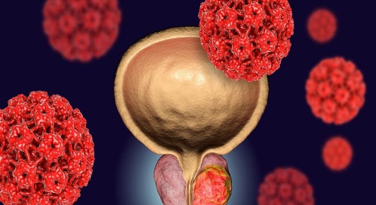 ESMO 2020 焦點：前列腺癌 PARP 抑制劑最新試驗結果