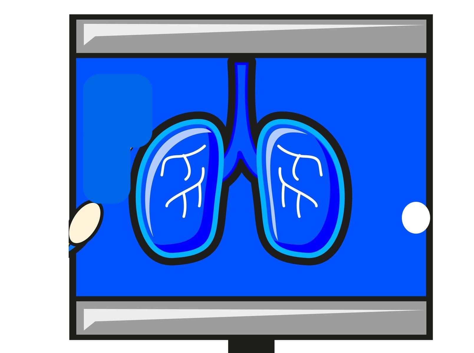雙免疫新藥抗 NSCLC? Arcus Biosciences 攜手 AstraZeneca 推 3 期臨床試驗