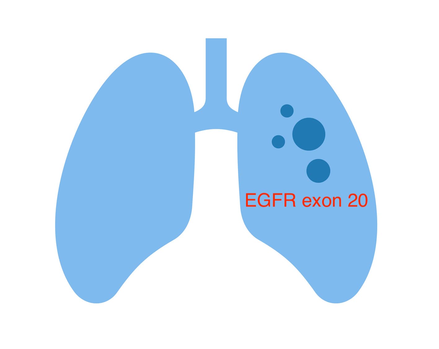 雙特異性抗體 amivantamab 突破 EGFR exon 20 突變肺癌治療困境?
