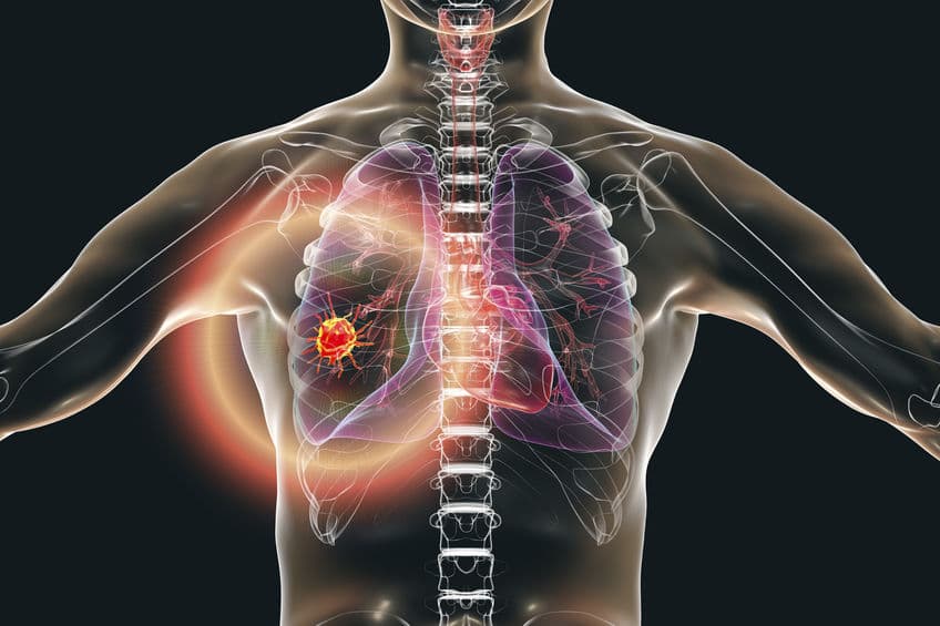 KRAS 突變 NSCLC 二線治療有解？Sotorasib 二期臨床顯 PFS 效益