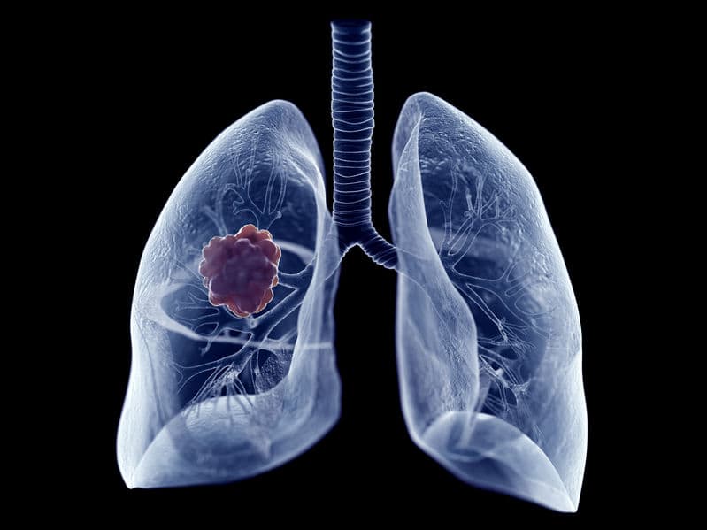 第一款 EGFR Exon 20 突變肺癌標靶藥獲 FDA 核准!