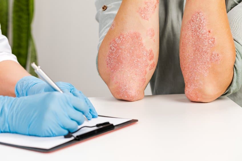 plaque psoriasis