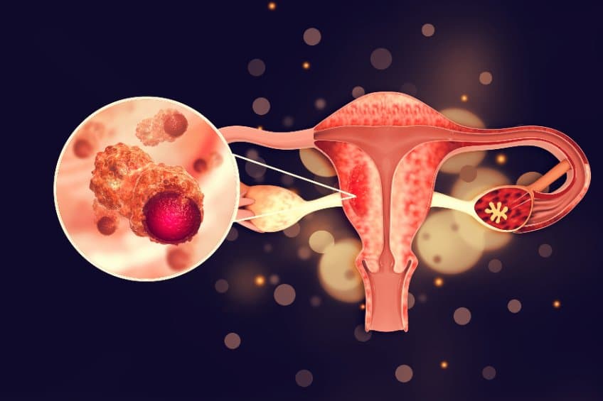 美 NIH 研究：女性使用直髮劑與罹患子宮內膜癌機率有關？