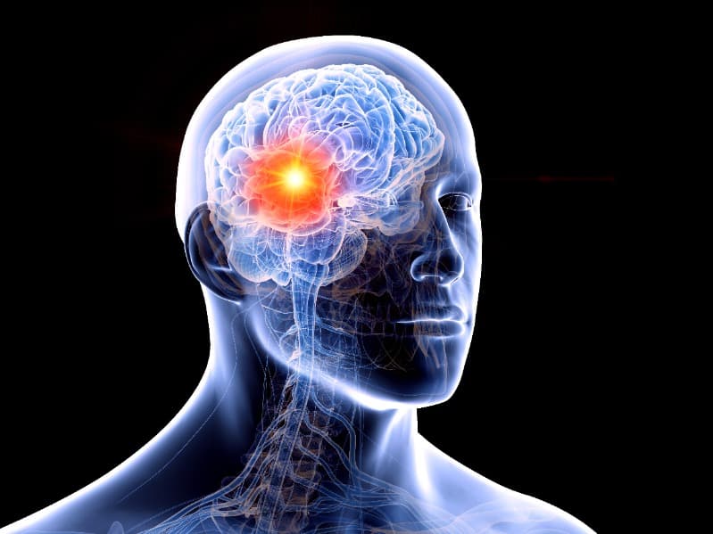 開發腦癌新療法，科學家發現不可逆電穿孔治療的應用潛力