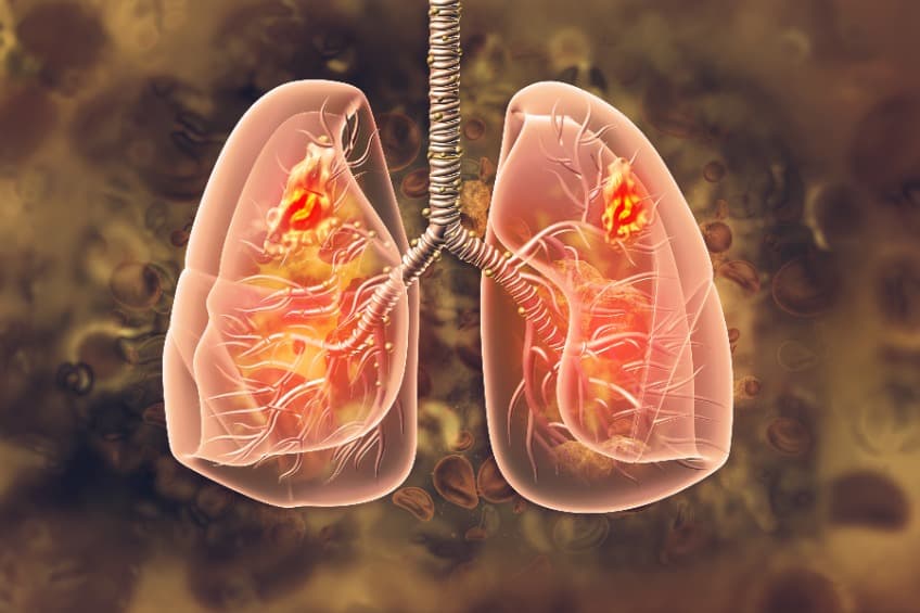 探索急性呼吸窘迫新療法,CFTR 調節劑現潛力