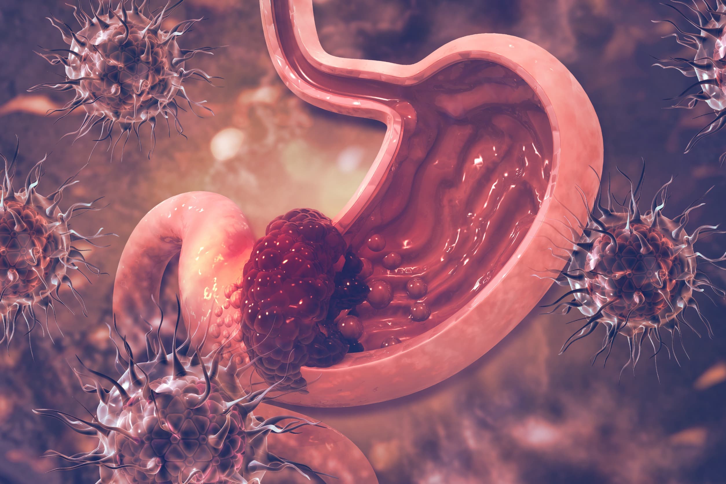 Zolbetuximab 三期試驗達標，Claudin18.2 成為轉移型胃癌新標靶