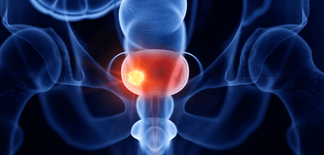 Bladder Cancer